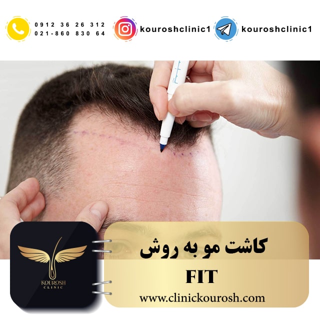 کاشت مو به روش FIT